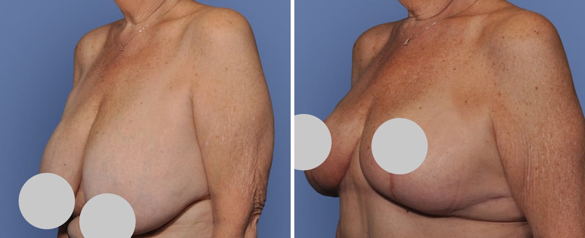 Breast Reduction Before & After Gallery - Patient 414433 - Image 2