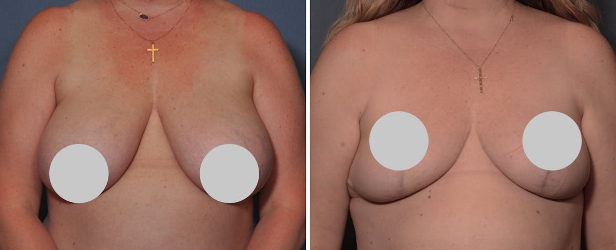 Breast Reduction Before & After Gallery - Patient 213618 - Image 1