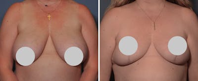 Breast Reduction Before & After Gallery - Patient 213618 - Image 1