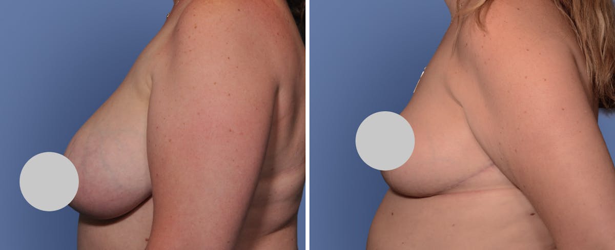 Breast Reduction Before & After Gallery - Patient 213618 - Image 2