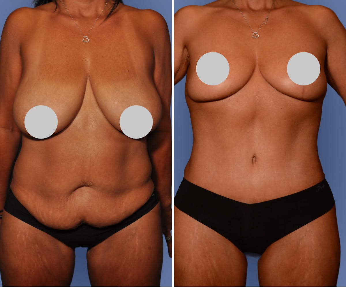 Breast Reduction Before & After Gallery - Patient 242597 - Image 1