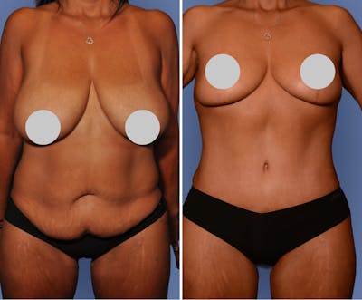 Breast Reduction Before & After Gallery - Patient 242597 - Image 1