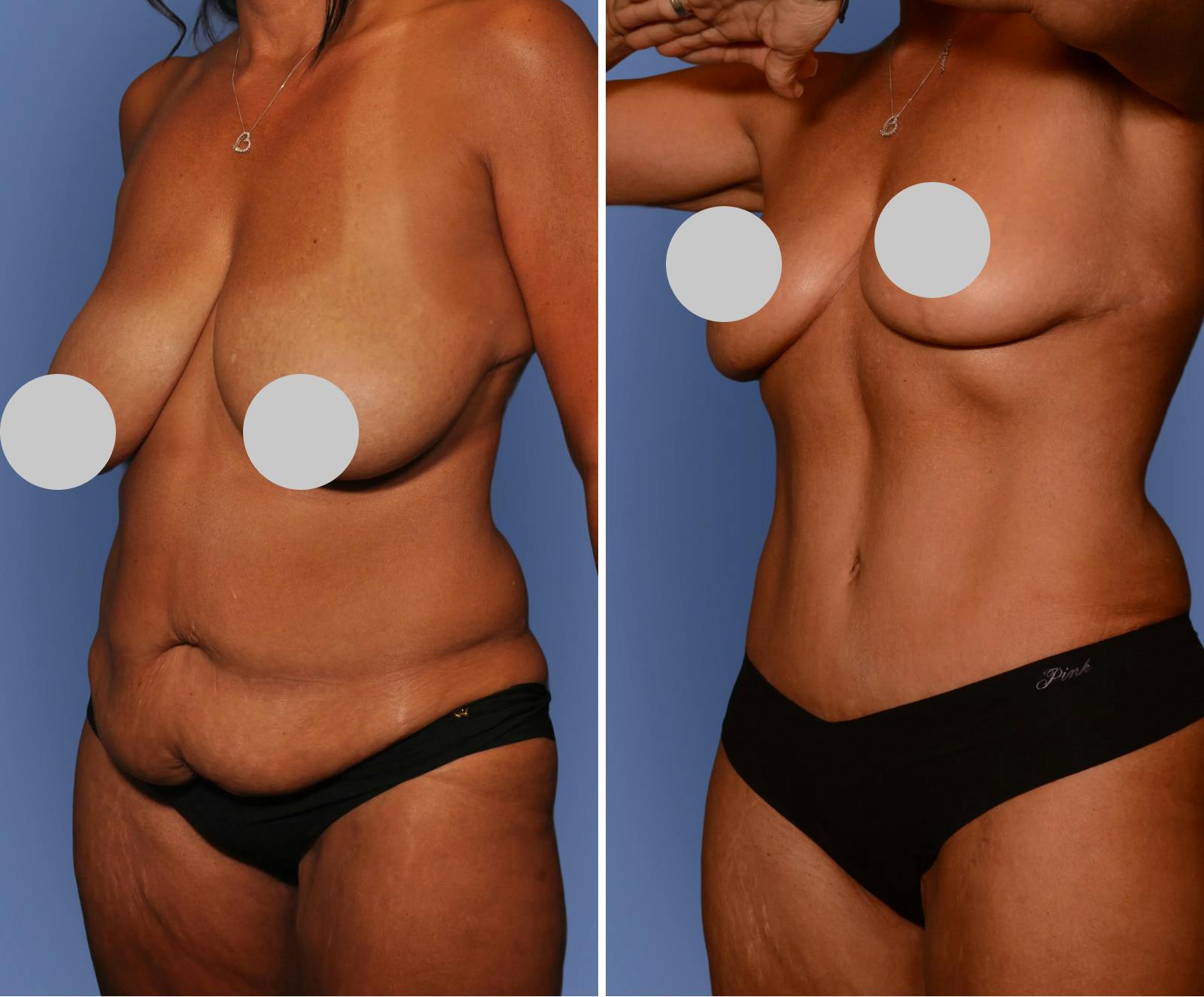 Breast Reduction Before & After Gallery - Patient 242597 - Image 2