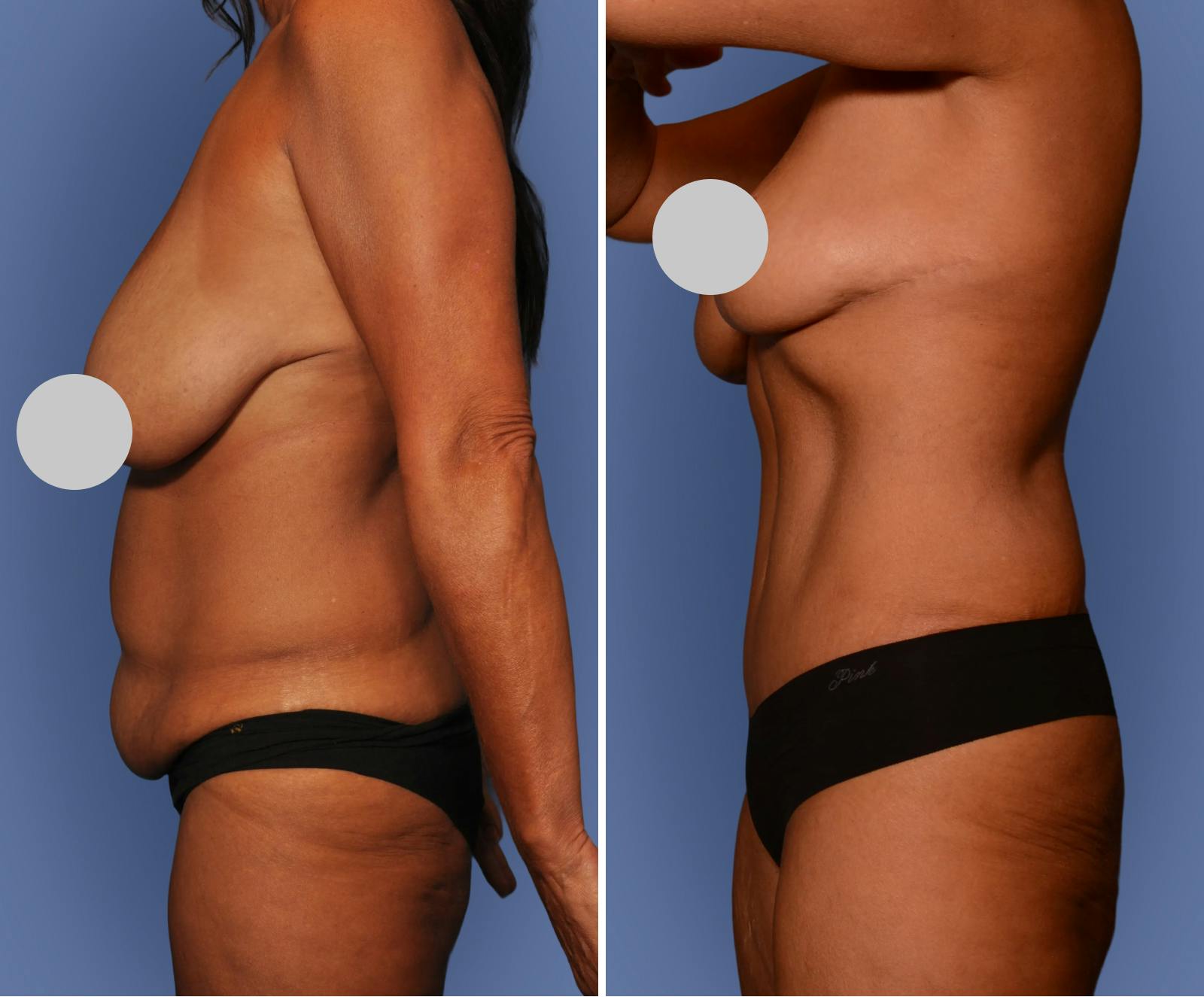 Breast Reduction Before & After Gallery - Patient 242597 - Image 3