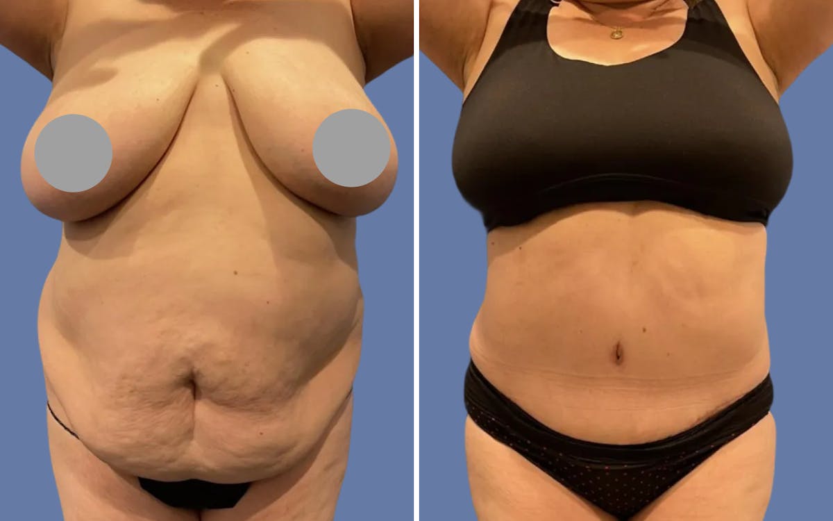 Abdominoplasty Before & After Gallery - Patient 215284 - Image 1