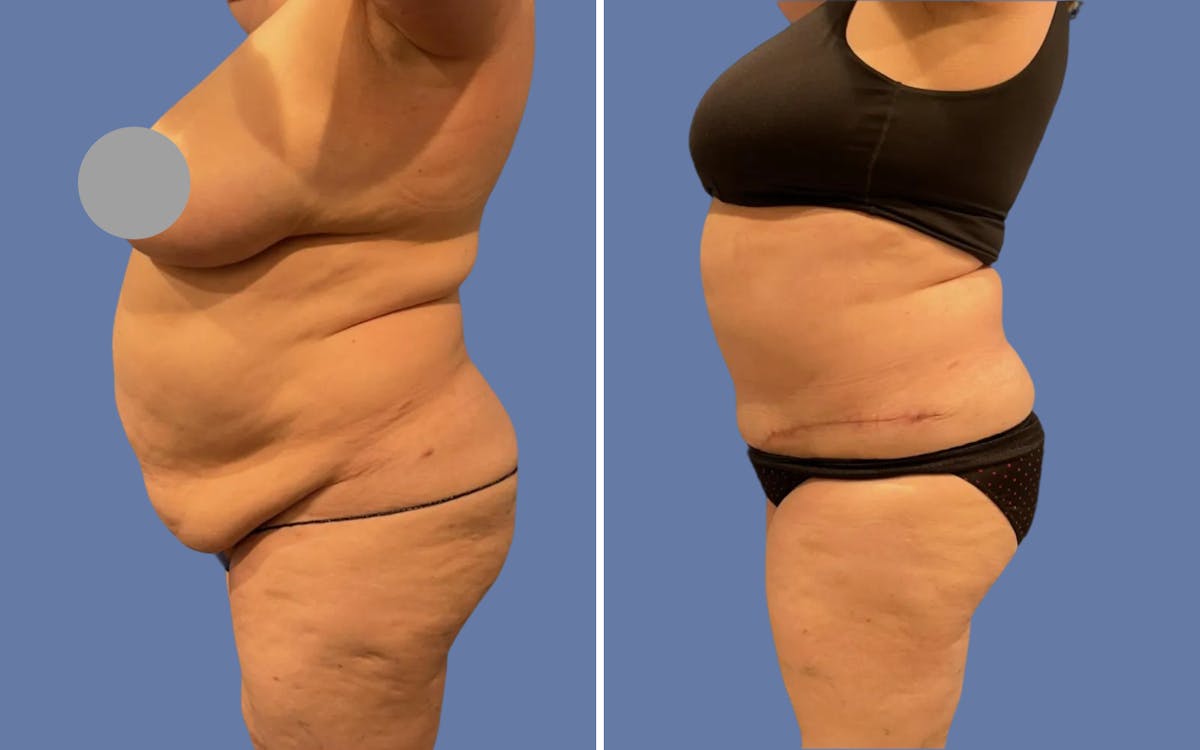 Abdominoplasty Before & After Gallery - Patient 215284 - Image 3