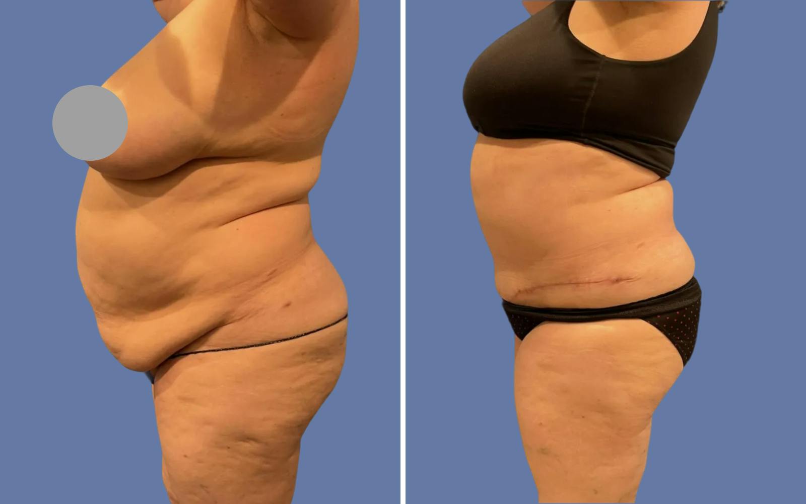 Abdominoplasty Before & After Gallery - Patient 215284 - Image 3