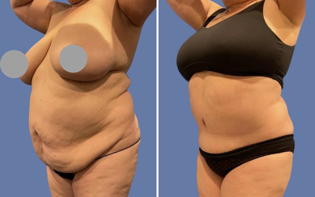 Abdominoplasty Before & After Gallery - Patient 215284 - Image 2