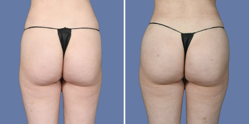 Patient Se8xHPO2Rj-6h8Qwcq_Czw - Brazilian Butt Lift Before & After Photos