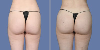 Brazilian Butt Lift Before & After Gallery - Patient 340273 - Image 1
