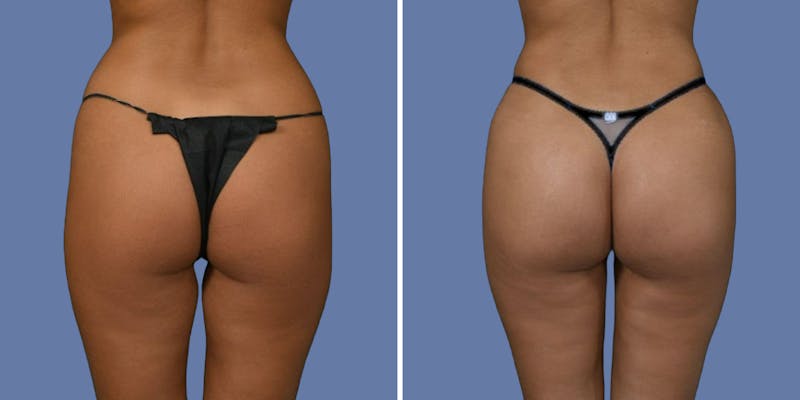 Patient f39s99MXSYKnLa38ZCHtrw - Brazilian Butt Lift Before & After Photos