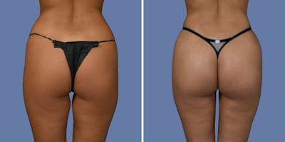 Brazilian Butt Lift Before & After Gallery - Patient 413790 - Image 1