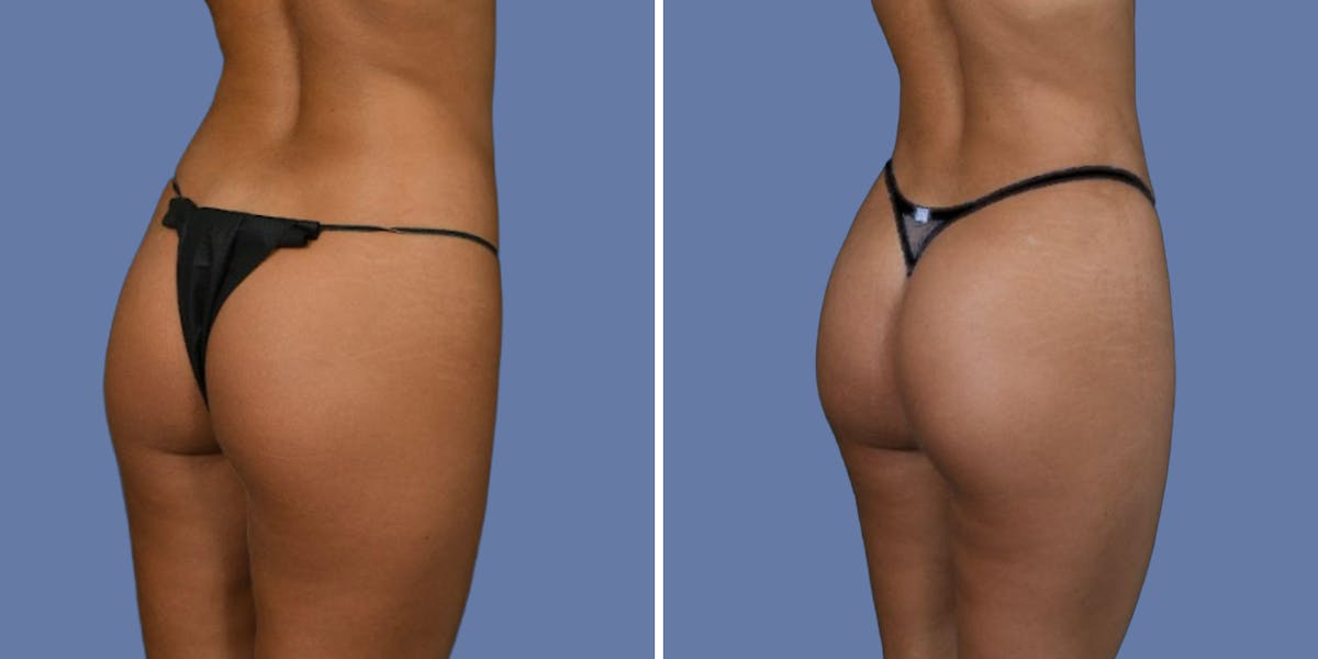 Brazilian Butt Lift Before & After Gallery - Patient 413790 - Image 2