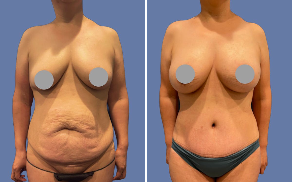 Mommy Makeover Before & After Gallery - Patient 973780 - Image 1