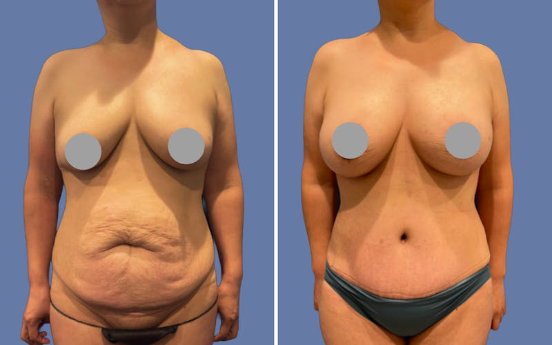 Patient RxB5GWTEQj2sxv287MxDOw - Mommy Makeover Before & After Photos