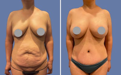 Mommy Makeover Before & After Gallery - Patient 973780 - Image 1