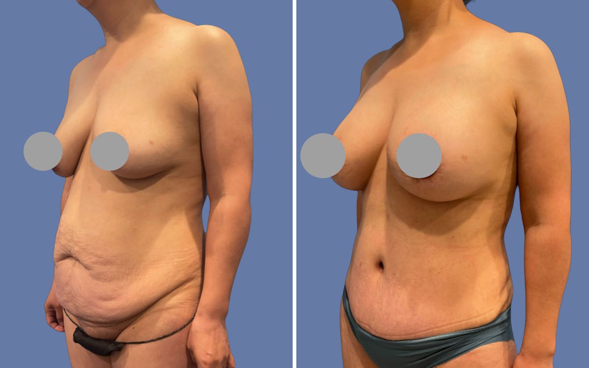 Mommy Makeover Before & After Gallery - Patient 973780 - Image 2