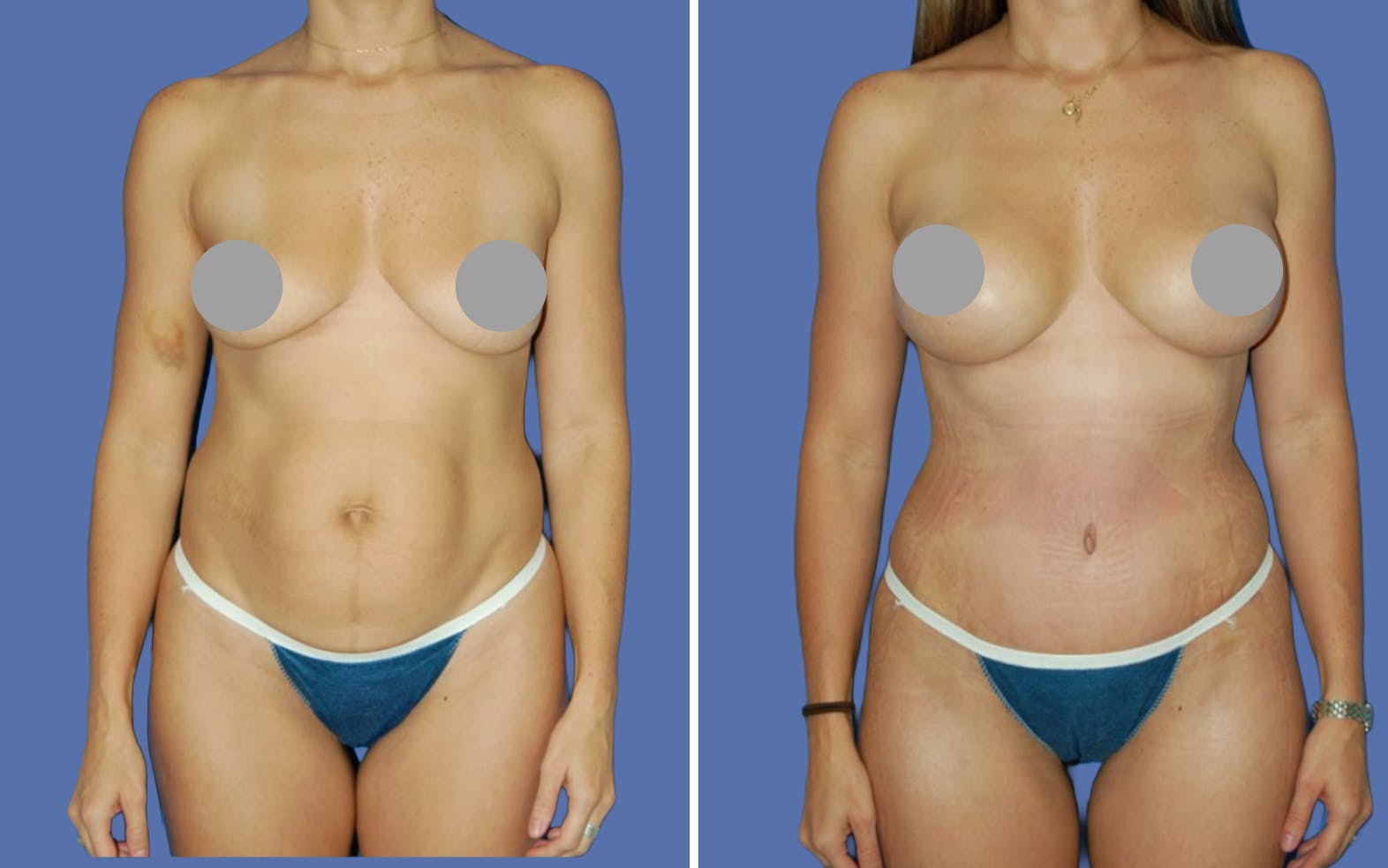 mommy makeover before media