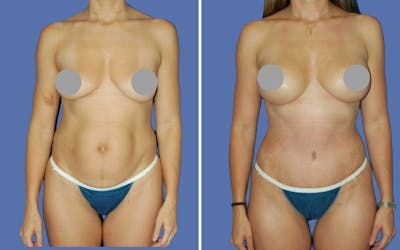 Mommy Makeover Before & After Gallery - Patient 672937 - Image 1