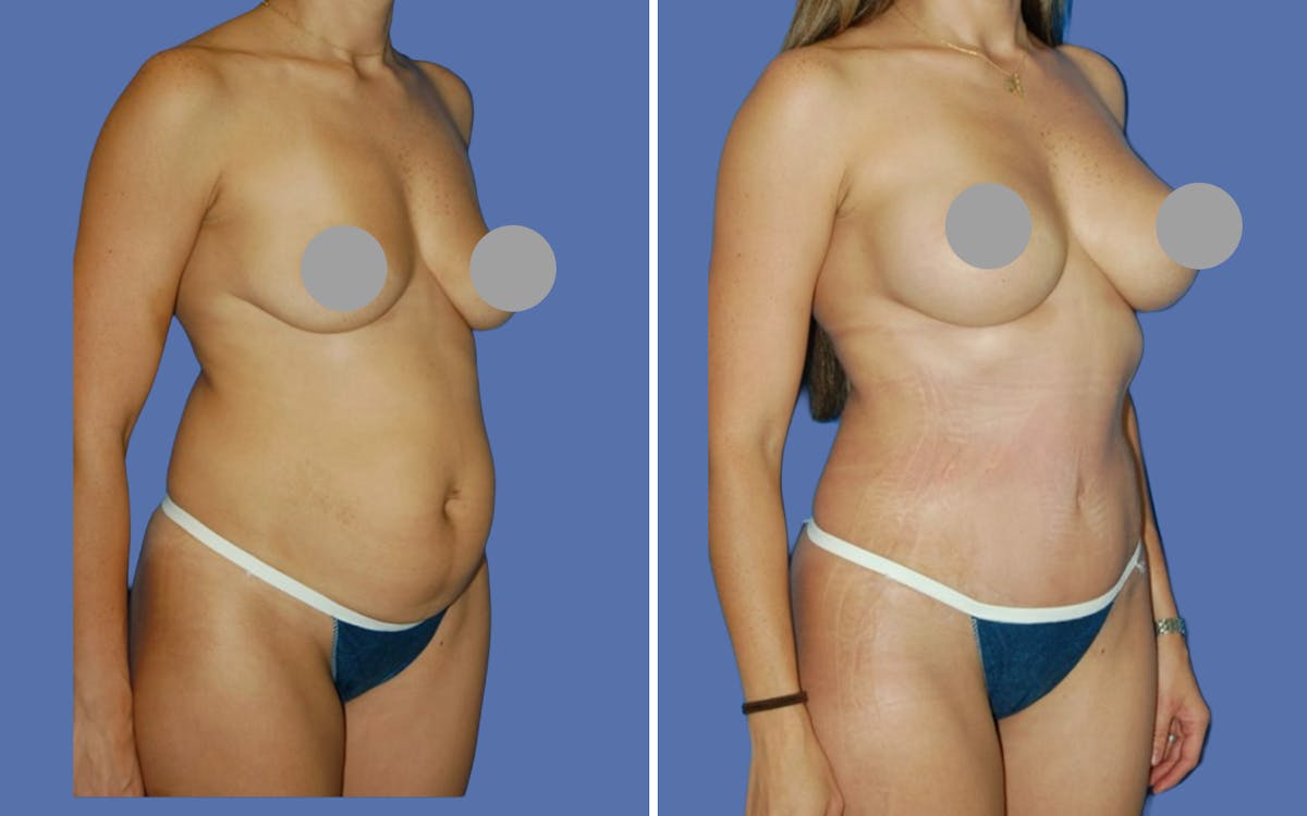 Mommy Makeover Before & After Gallery - Patient 672937 - Image 2