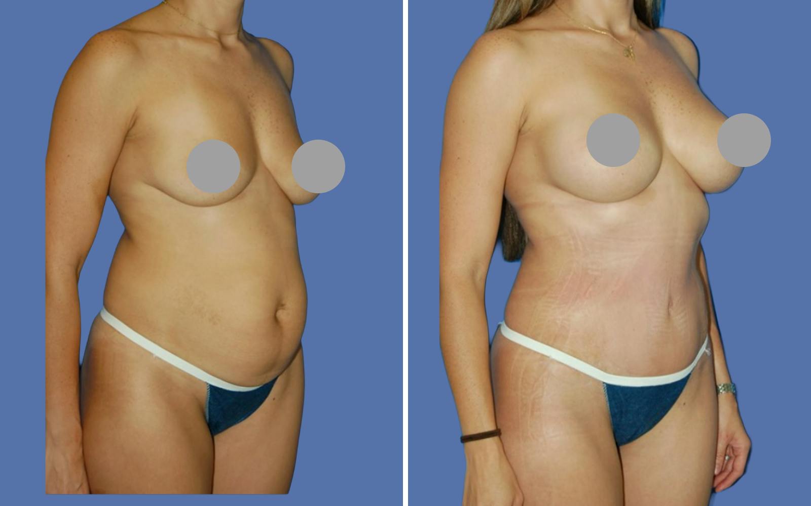 Mommy Makeover Before & After Gallery - Patient 672937 - Image 2