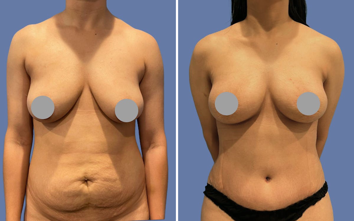 Mommy Makeover Before & After Gallery - Patient 293956 - Image 1