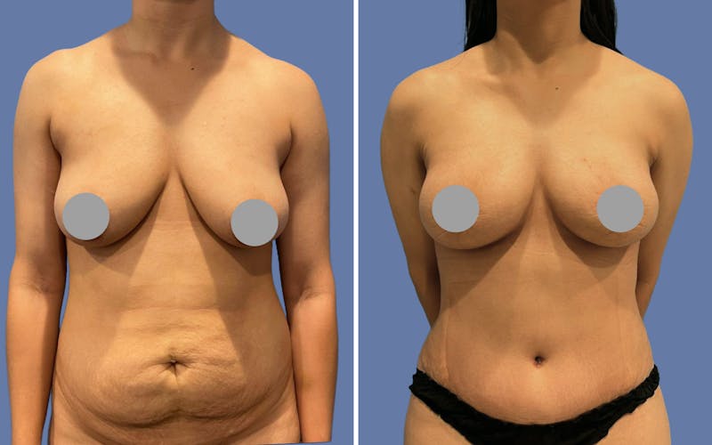 Patient NOFrEHS8QGe8JXseZI1j9Q - Mommy Makeover Before & After Photos