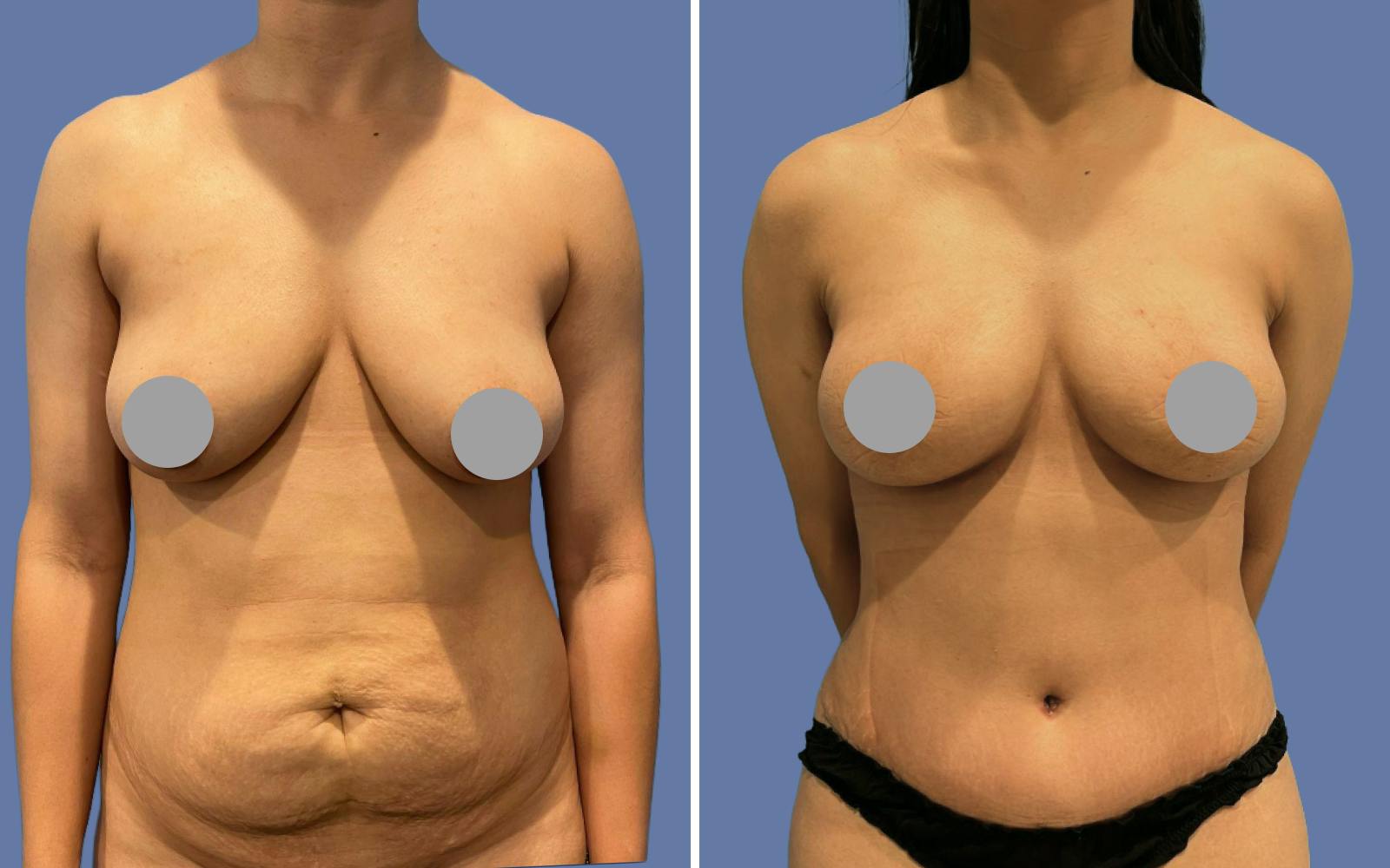 Mommy Makeover Before & After Gallery - Patient 293956 - Image 1