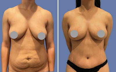 Mommy Makeover Before & After Gallery - Patient 293956 - Image 1