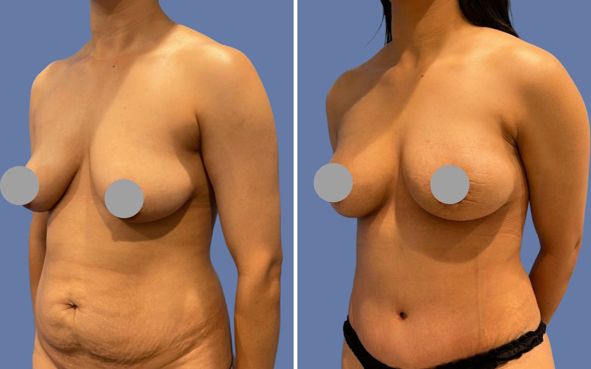 Mommy Makeover Before & After Gallery - Patient 293956 - Image 2