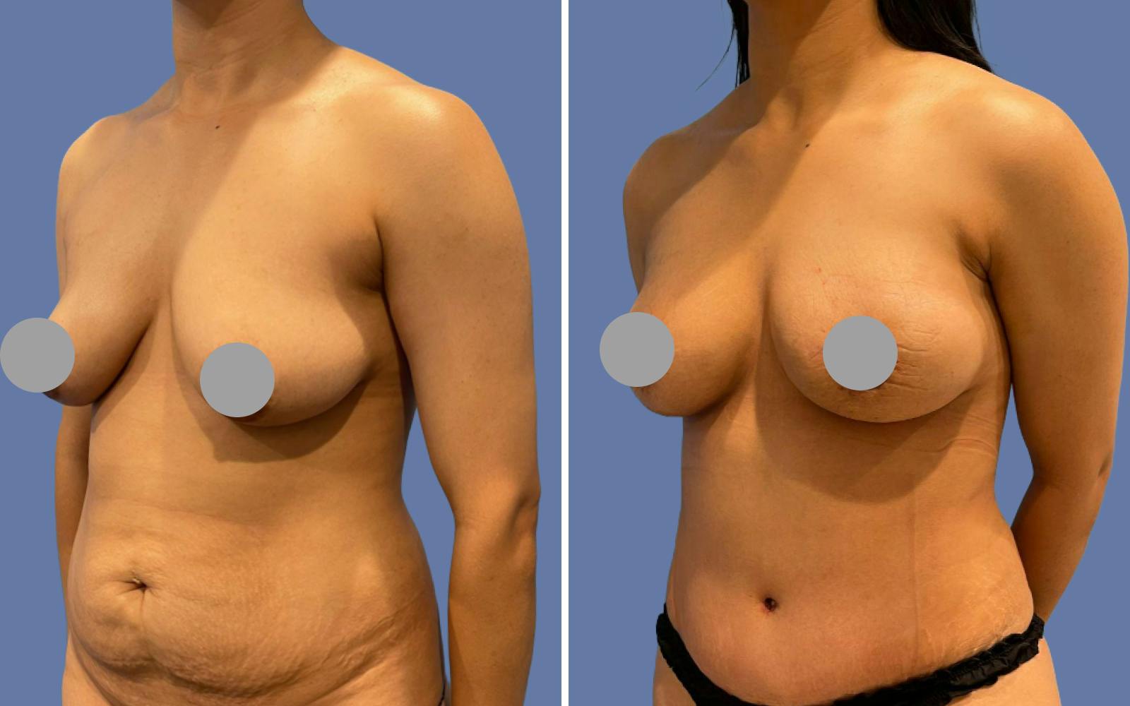 Mommy Makeover Before & After Gallery - Patient 293956 - Image 2