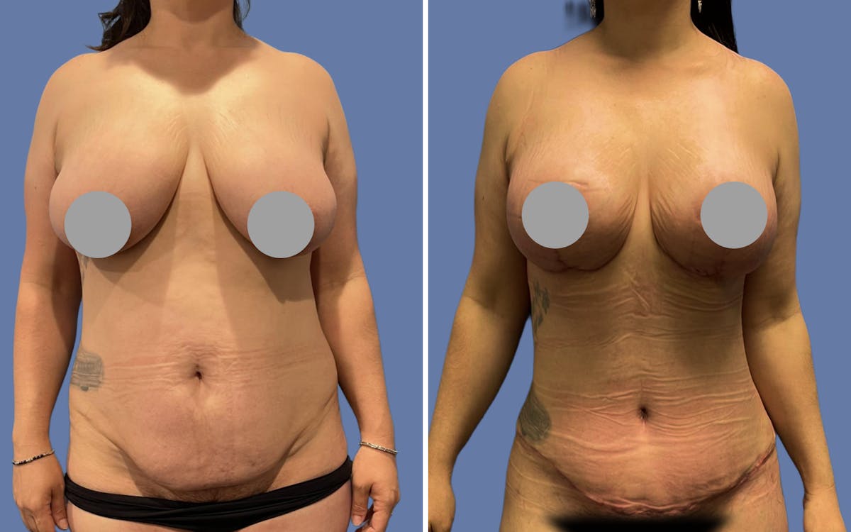 Mommy Makeover Before & After Gallery - Patient 188809 - Image 1