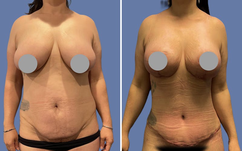 Patient QZNB8NVkSj6qVbYHWbO3yA - Mommy Makeover Before & After Photos