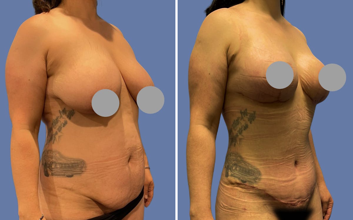 Mommy Makeover Before & After Gallery - Patient 188809 - Image 2