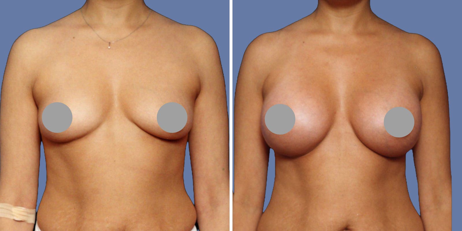 Breast Augmentation Before & After Gallery - Patient 428893 - Image 1