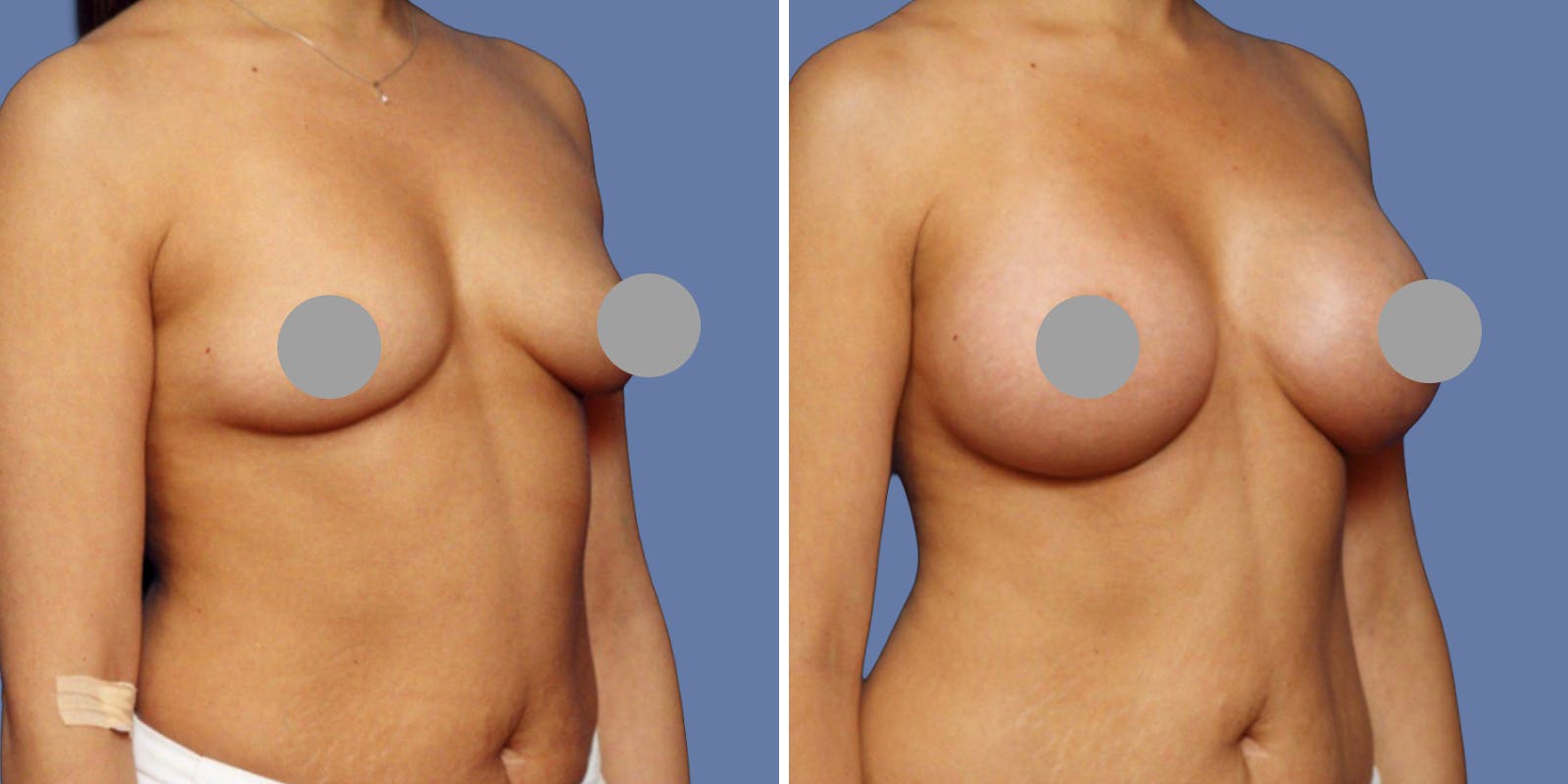 Breast Augmentation Before & After Gallery - Patient 428893 - Image 2