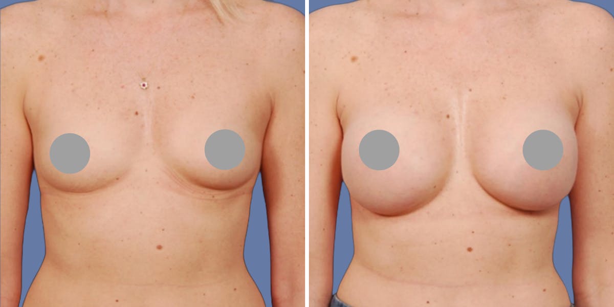 Breast Augmentation Before & After Gallery - Patient 115356 - Image 1