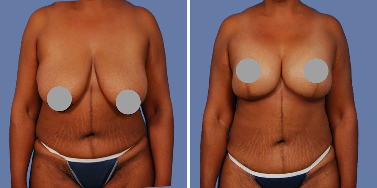 Breast Augmentation Before & After Gallery - Patient 265991 - Image 1