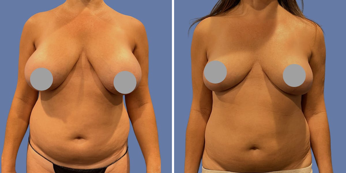 Breast Augmentation Before & After Gallery - Patient 392001 - Image 1