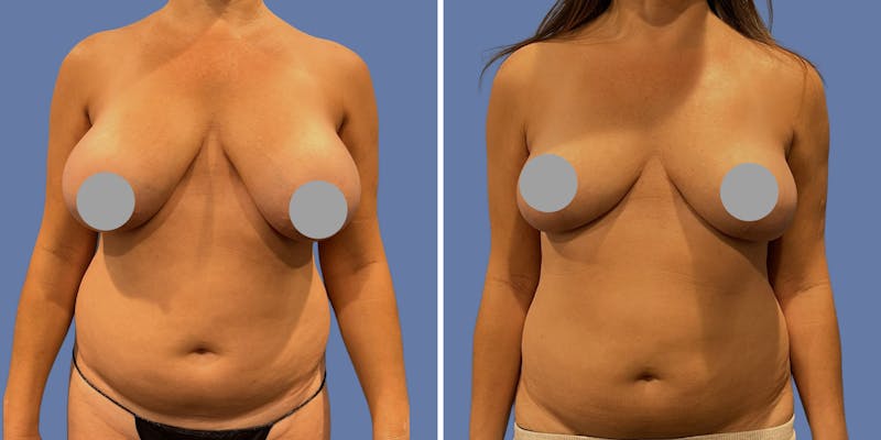 Patient JUKi3Kr9TMaQuwW0KacZWw - Breast Augmentation Before & After Photos