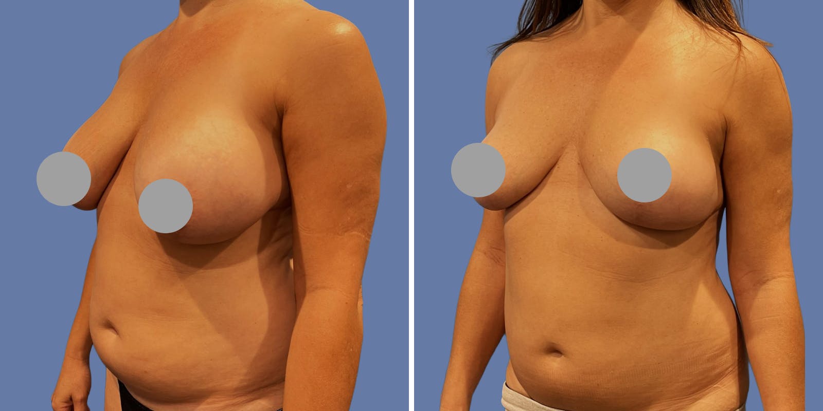 Breast Augmentation Before & After Gallery - Patient 392001 - Image 2