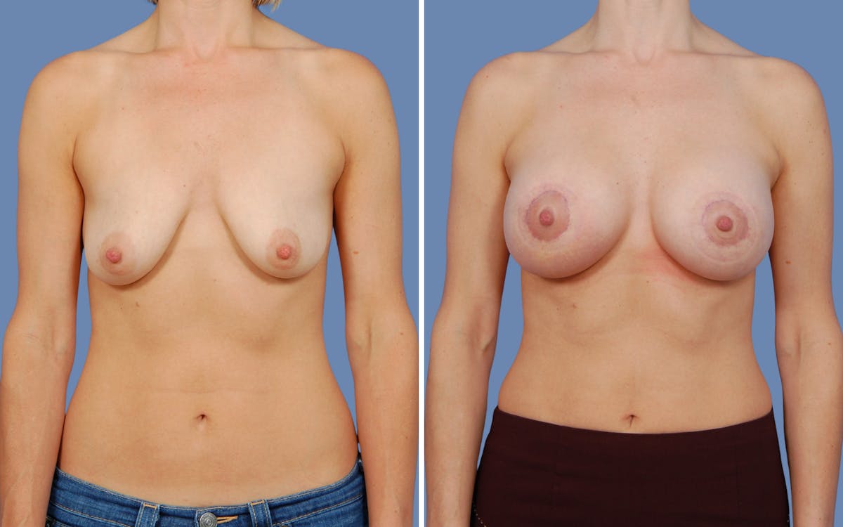 “Donut” Mastopexy Before & After Gallery - Patient 236427 - Image 1