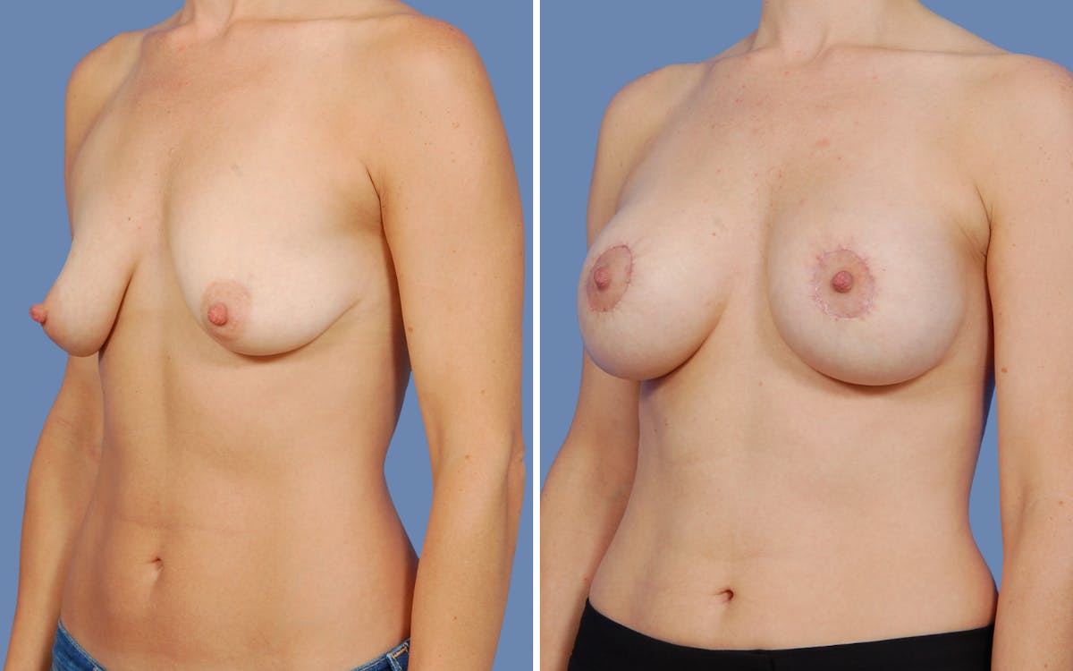 “Donut” Mastopexy Before & After Gallery - Patient 236427 - Image 2