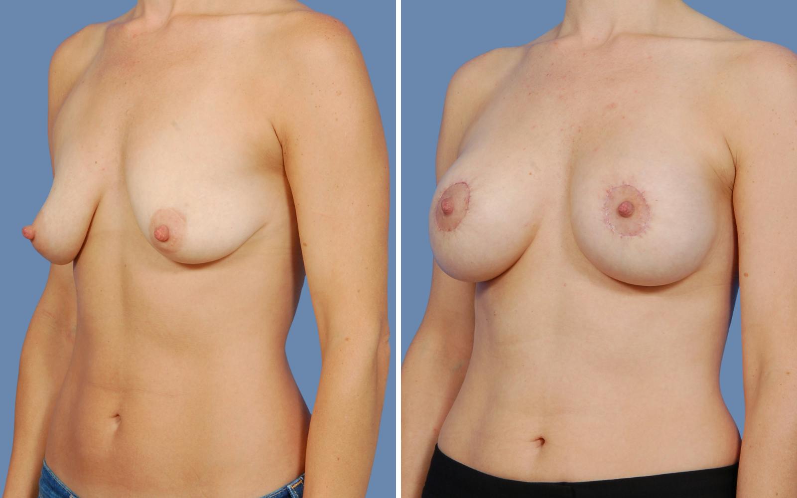 “Donut” Mastopexy Before & After Gallery - Patient 236427 - Image 2