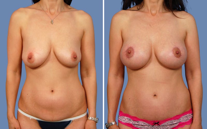 “Donut” Mastopexy Before & After Gallery - Patient 180186 - Image 1