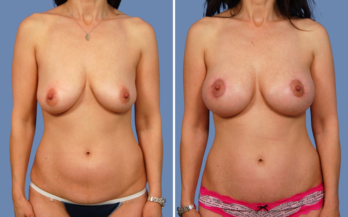 “Donut” Mastopexy Before & After Gallery - Patient 180186 - Image 1
