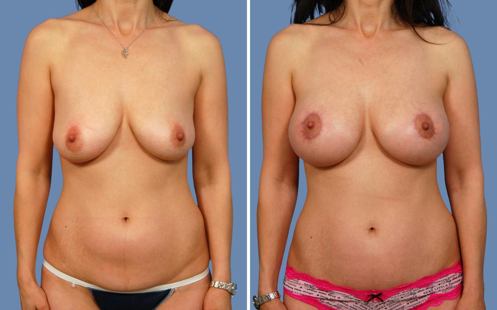 “Donut” Mastopexy Before & After Gallery - Patient 180186 - Image 1