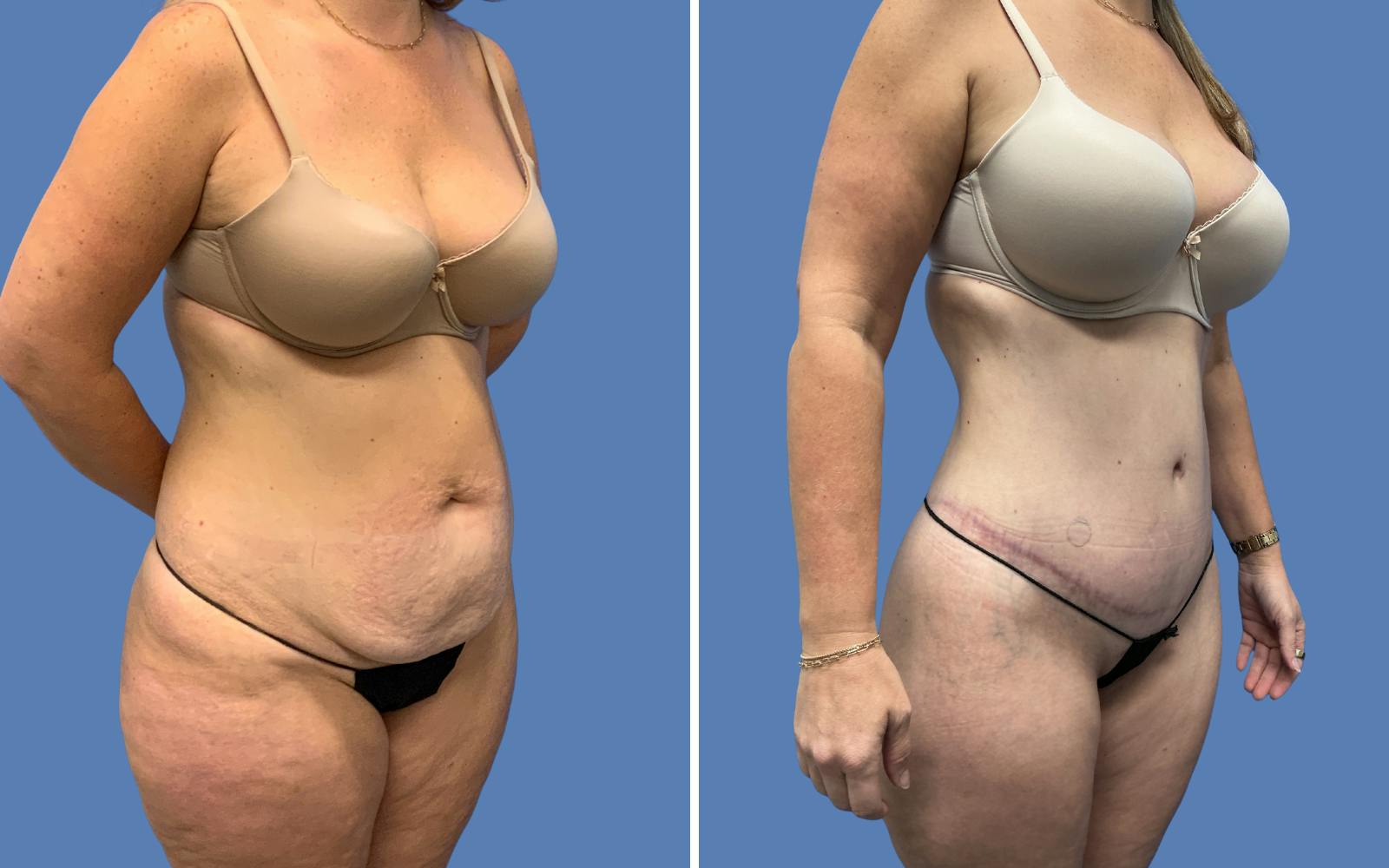 Abdominoplasty Before & After Gallery - Patient 501101 - Image 2