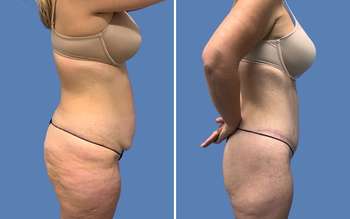 Abdominoplasty Before & After Gallery - Patient 501101 - Image 3