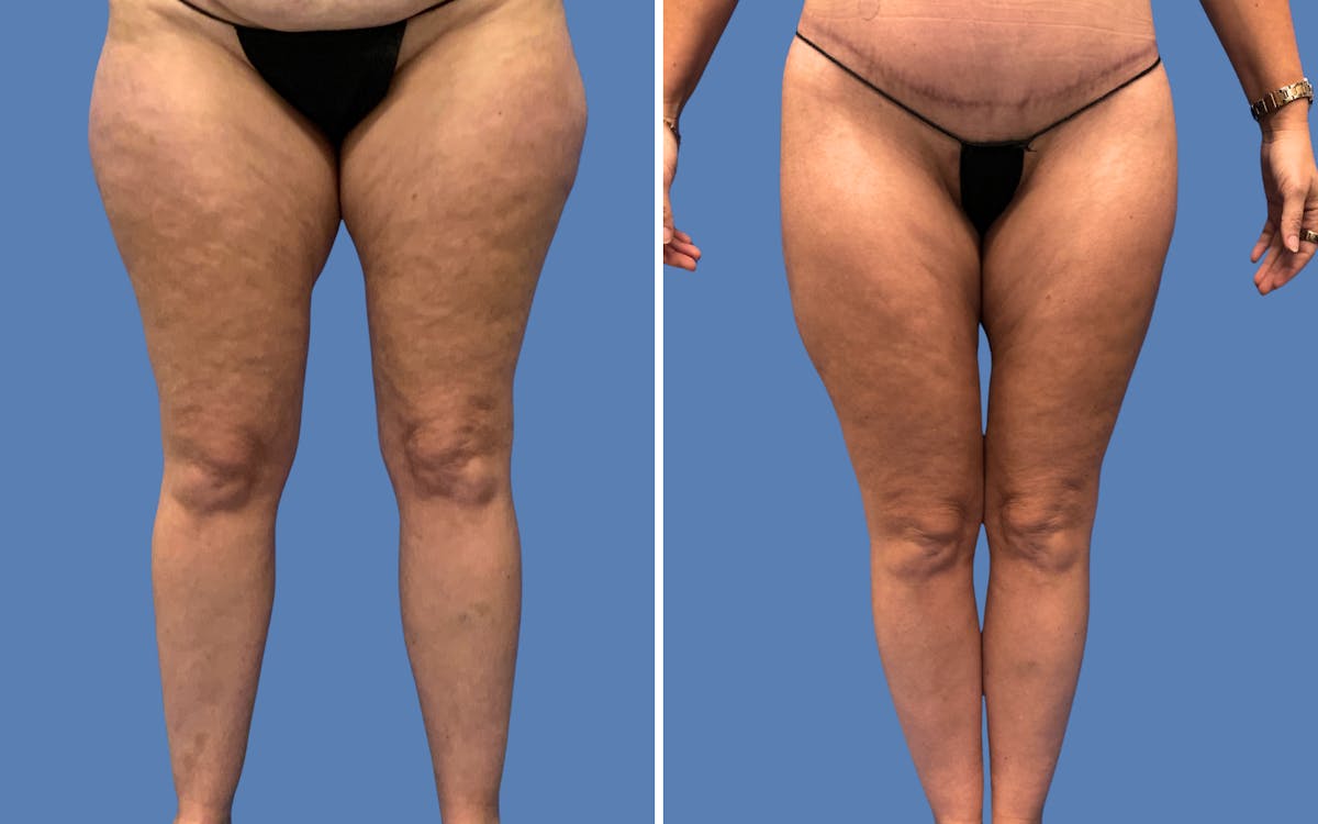 Abdominoplasty Before & After Gallery - Patient 501101 - Image 4